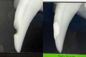 x-ray of canine tooth filling before and after